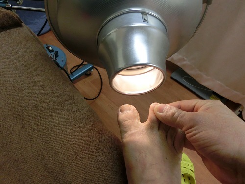 7月、8月と裸足で過ごしていたら水虫と爪水虫になりました。コウケントー光線治療方法を教えてください。