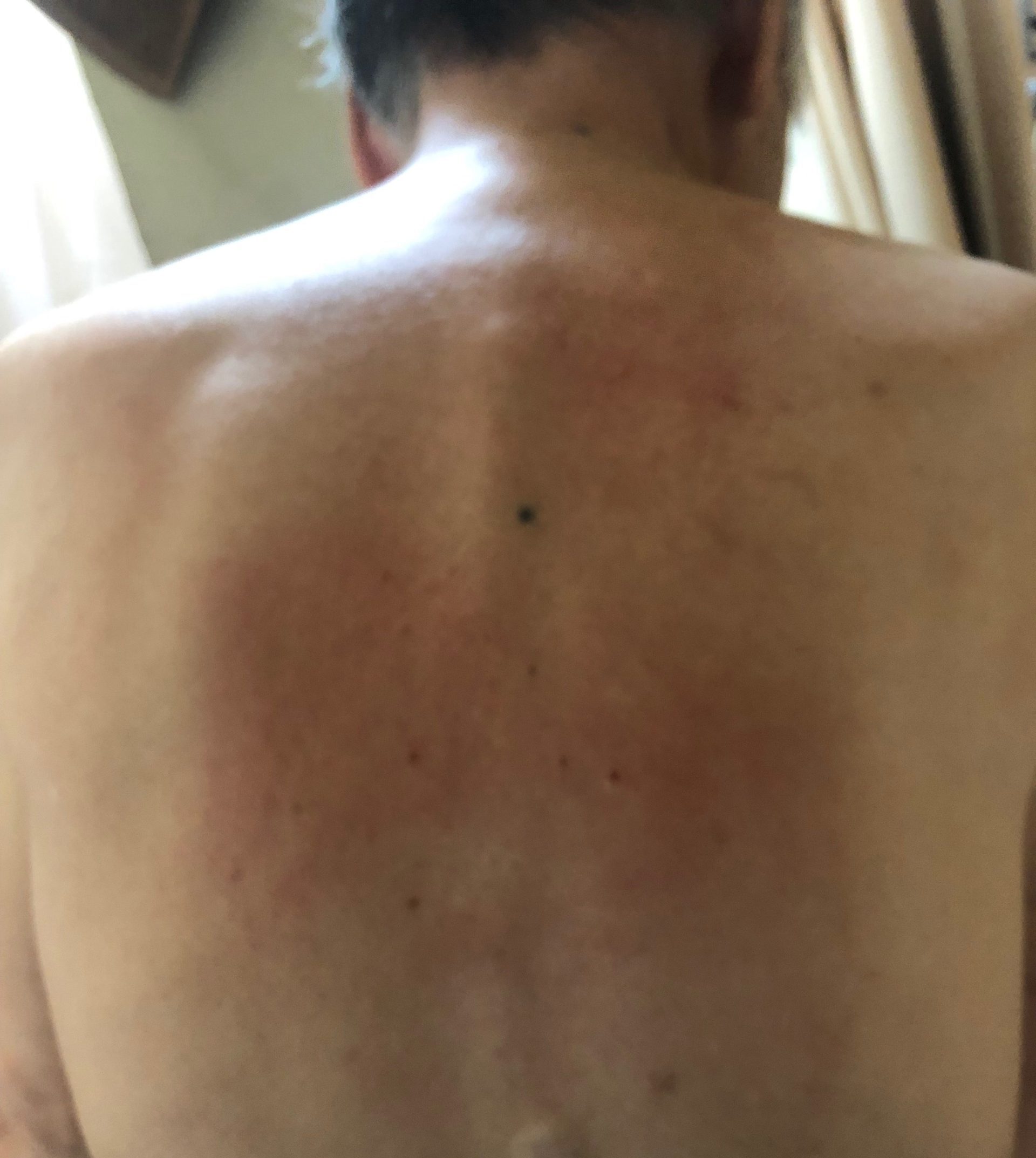 初めてのコウケントー光線治療で肌が赤くなりました。湿疹のようなブツブツも出ました。➡光線を当てて本来の肌にしましょう。