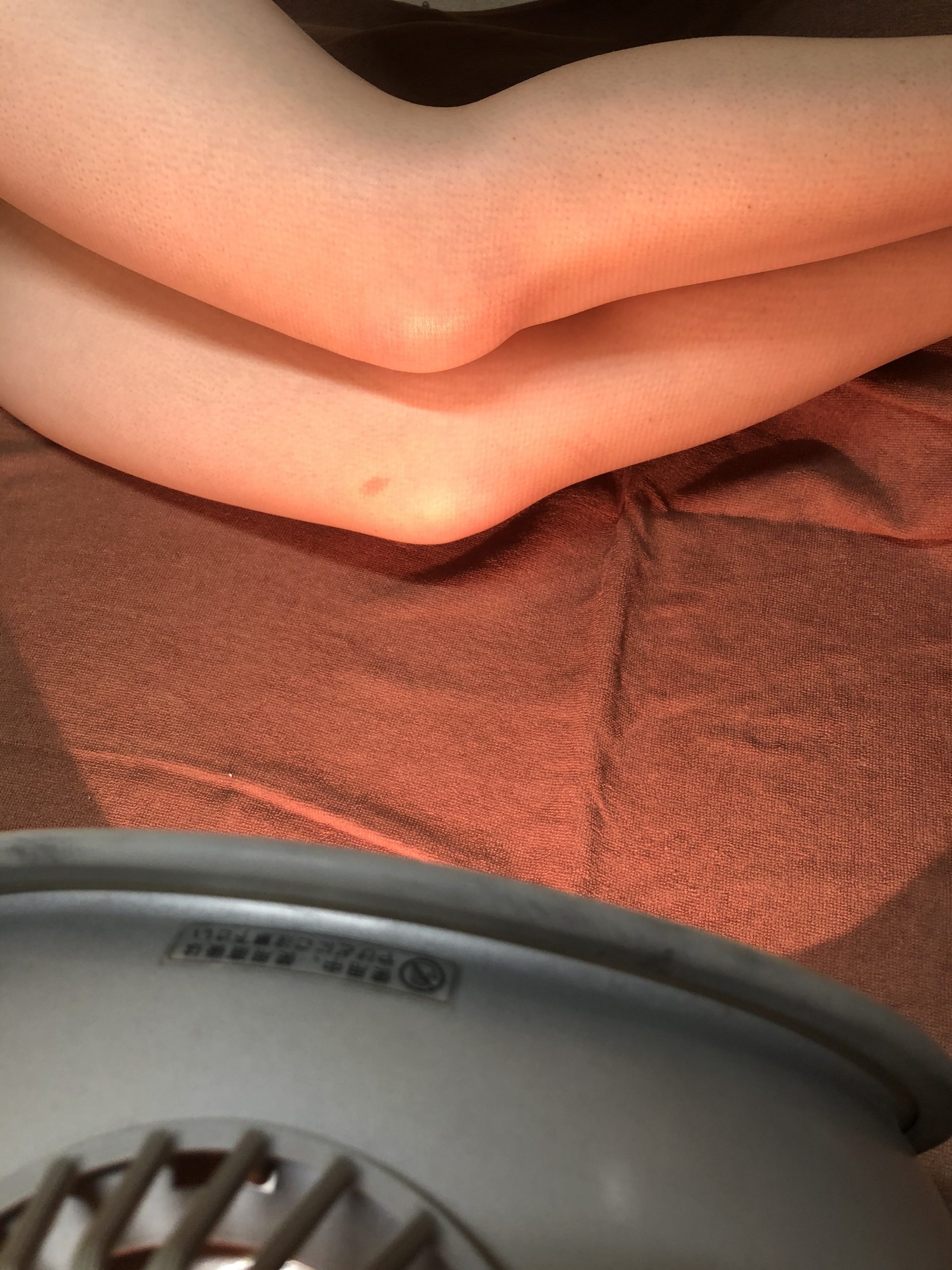 H・Mさん73歳女性、膝に水が溜まった時のコウケントー光線治療