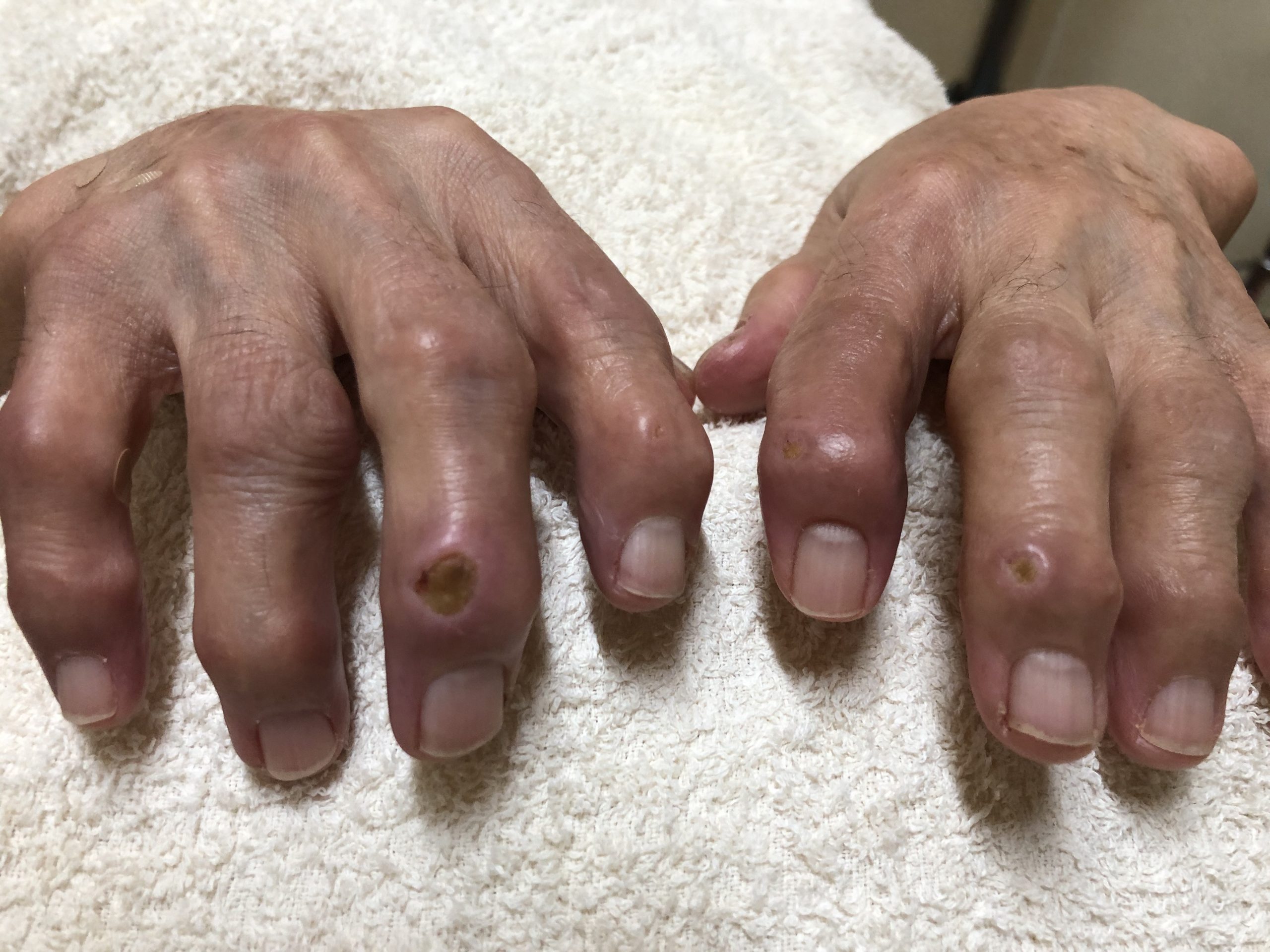 O・Ｋさん50歳女性、指先を使うお仕事でへバーデン結節の痛みが辛い時のコウケントー光線治療。