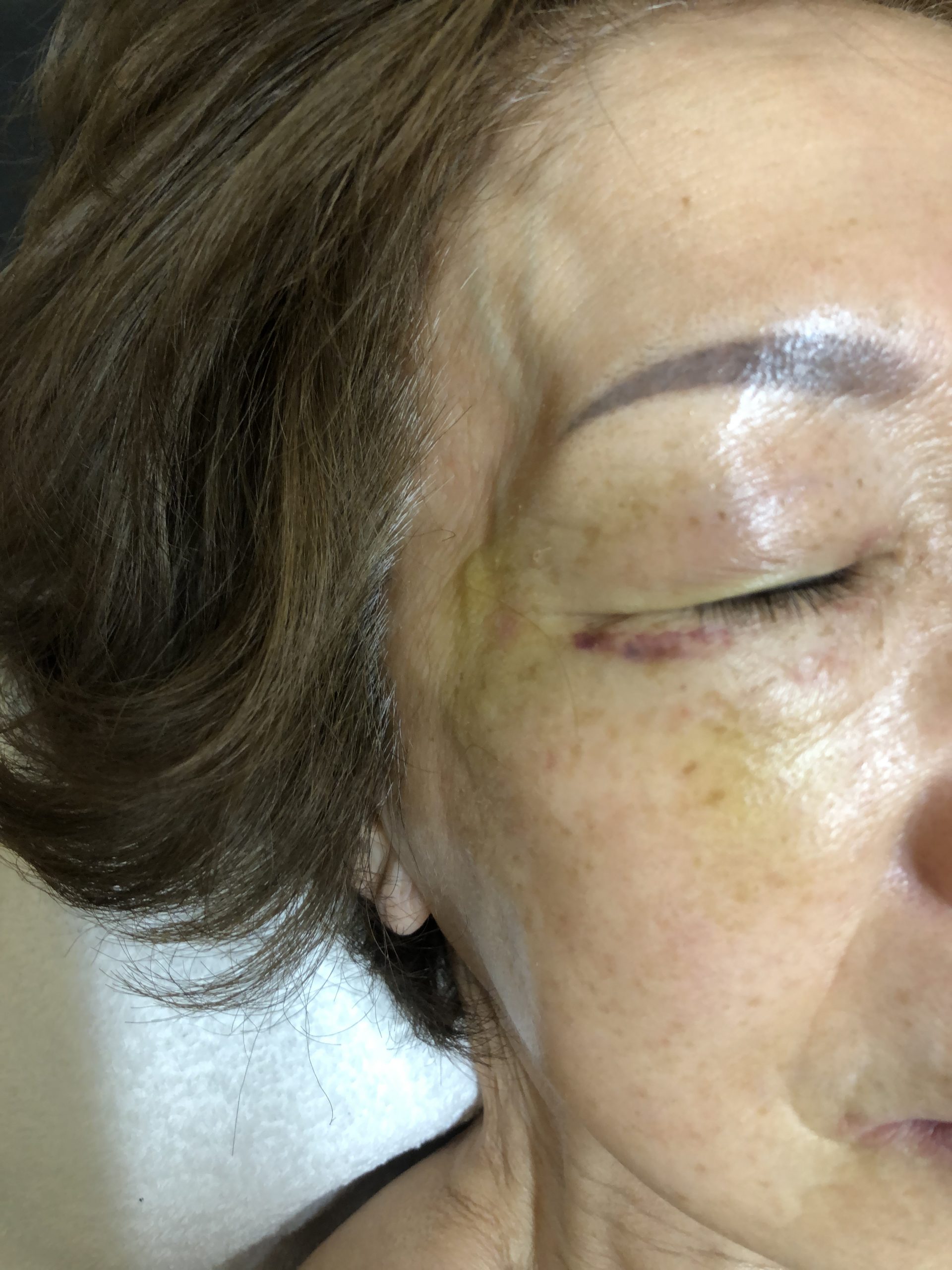 W・Hさん77歳女性、顔面打撲のコウケントー光線療法