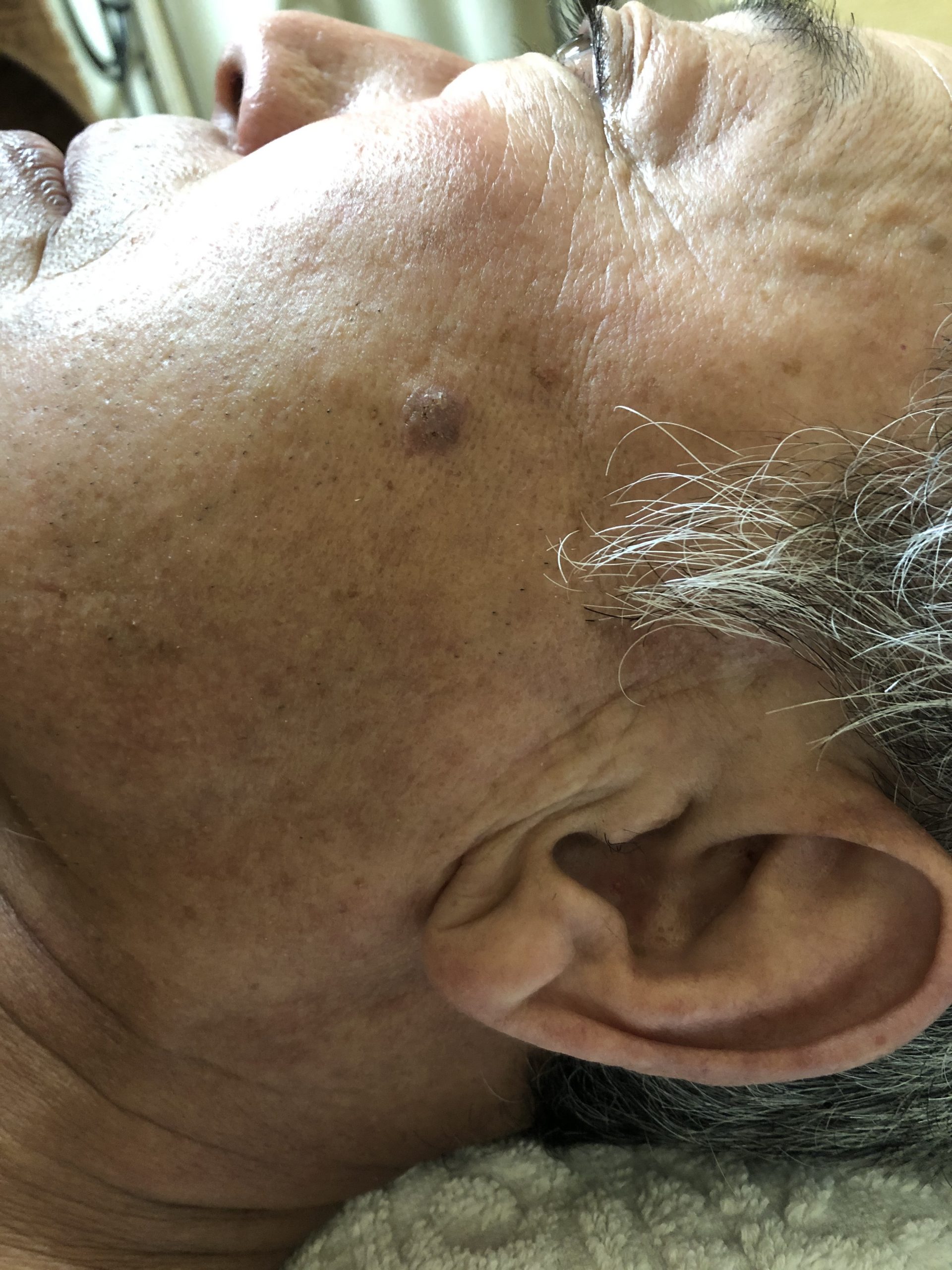 70歳男性、お顔に出来たイボを取りたい時のコウケントー光線治療