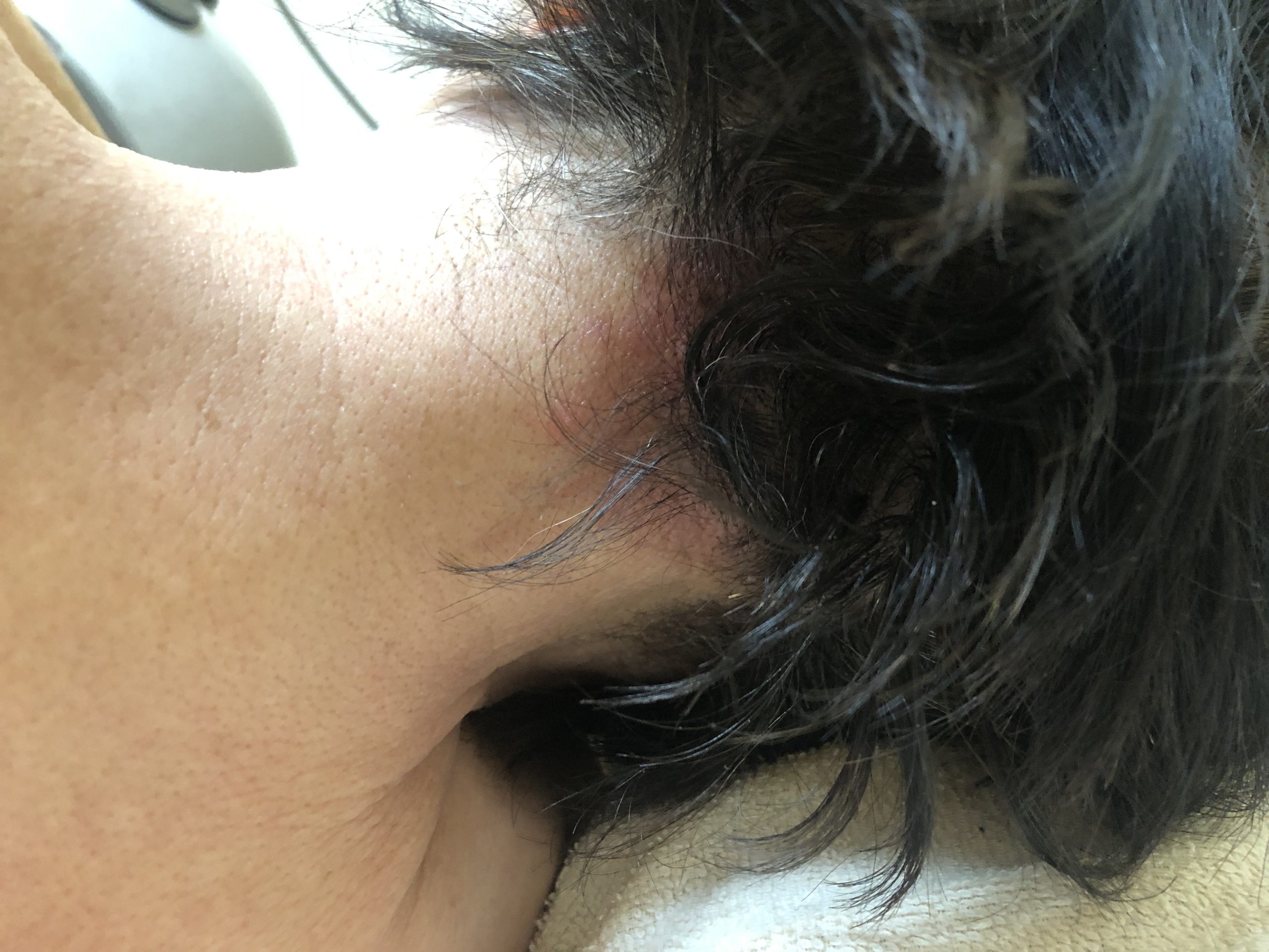頭皮のブツブツ、白い粉(皮膚片)、痒み、脂漏性湿疹などはコウケントー光線治療も活用してみる。