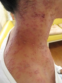 大人になってからひどくなったアトピー性皮膚炎のコウケントー光線療法。A・Mさん33歳女性。