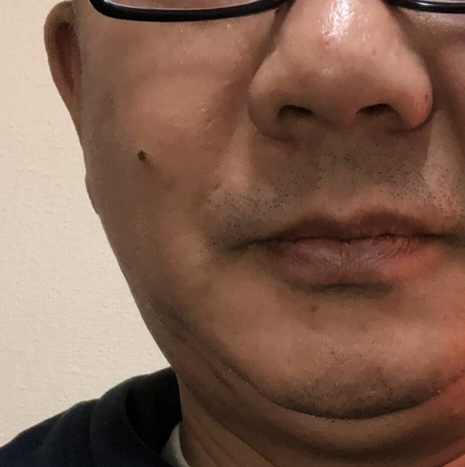 36歳男性、顎関節が痛くなり歯科医に行ったら単なる顎関節周辺の筋肉痛と言われた時にコウケントー光線治療