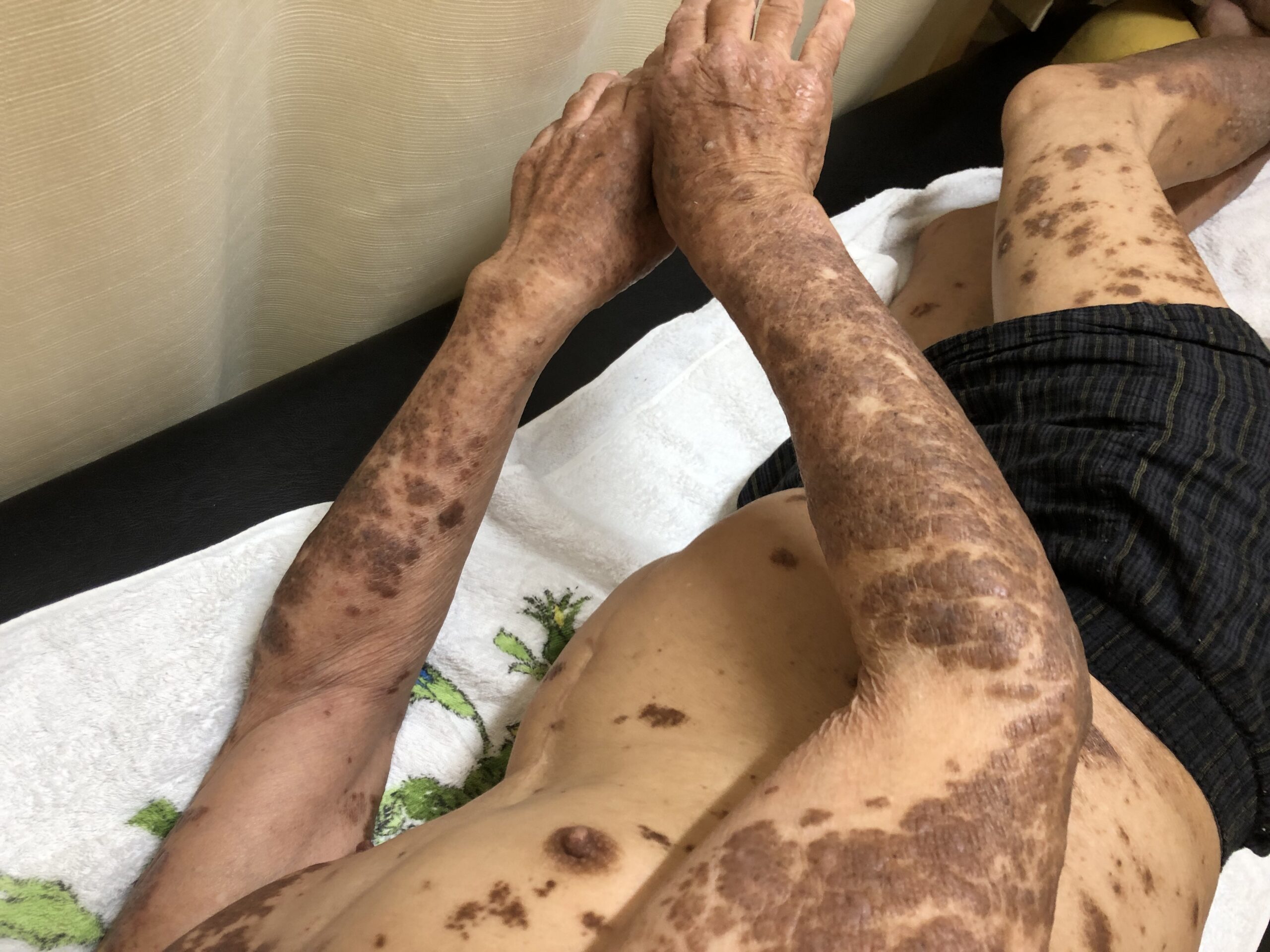 やっぱりコウケントー光線治療ってすごいし、不思議だなぁって思う。こんなに酷い難治性の皮膚疾患が良くなるんだから。