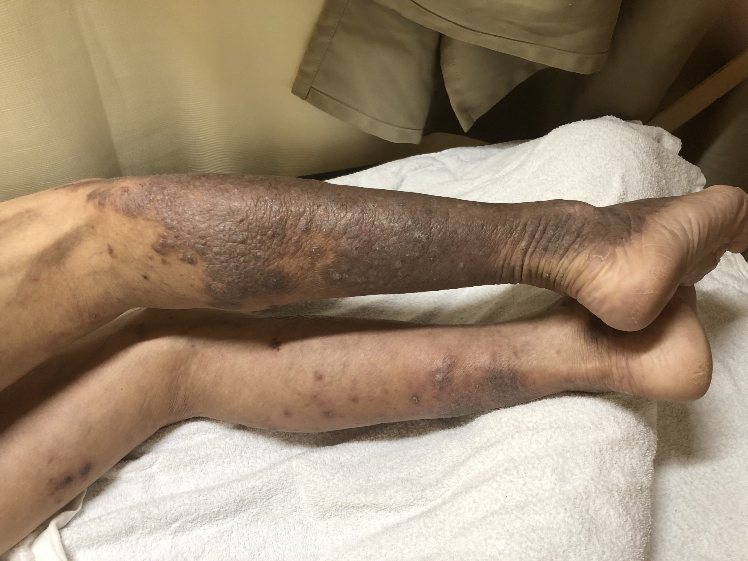 乾癬、掌蹠膿疱症、謎の湿疹など皮膚科の治療とコウケントー光線治療