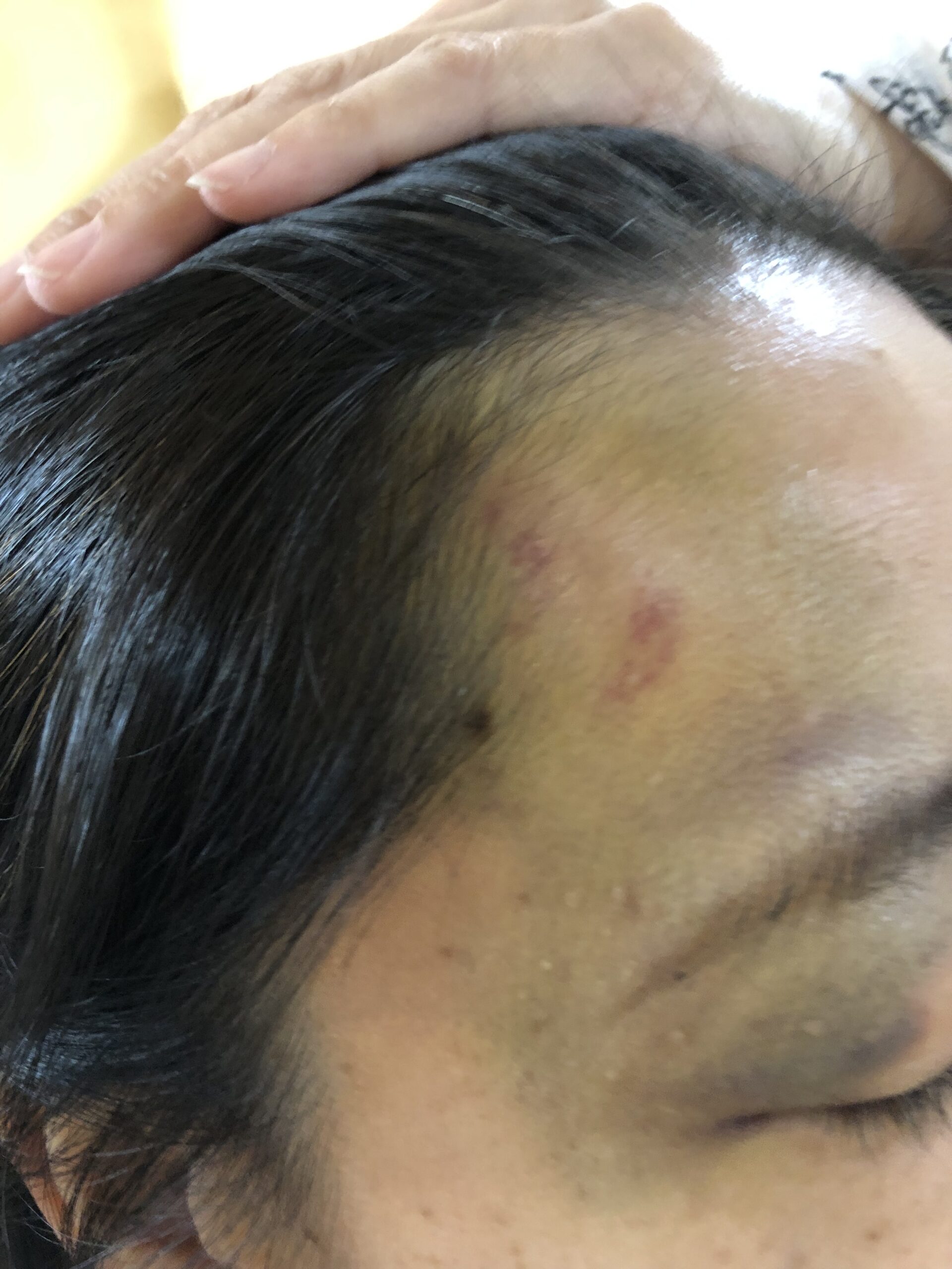 40歳代女性、酔っぱらって転倒し顔面を打撲してコウケントー光線治療