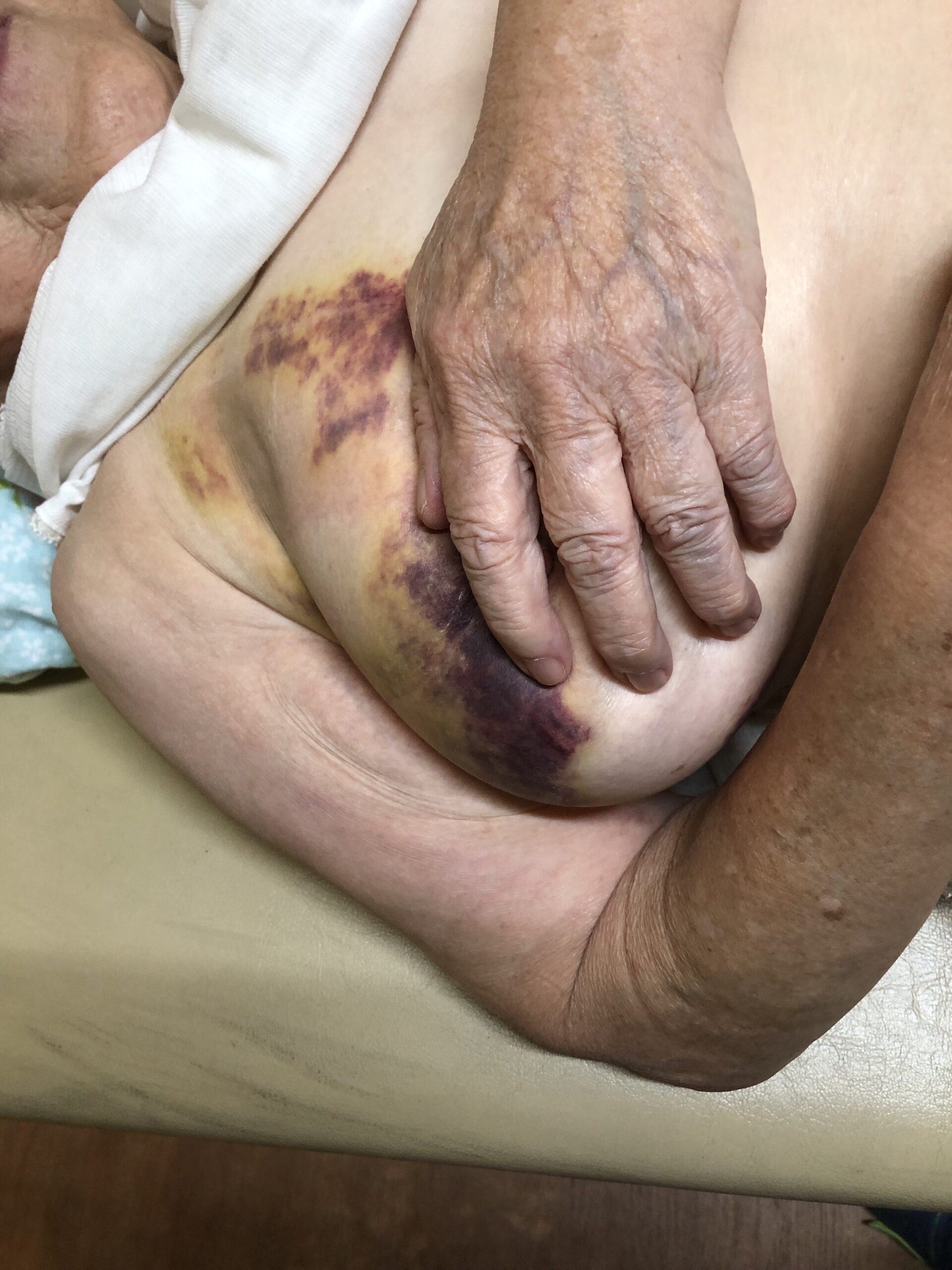 Y・Hさん77歳女性、1週間前にお寺さんの境内で転倒して右胸部～右上腕部を打撲してコウケントー光線治療