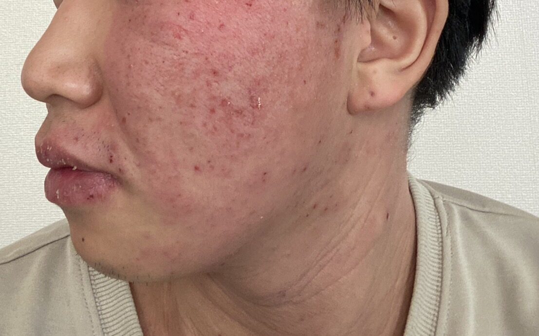 アトピー性皮膚炎はコウケントー光線治療3001-3002番を使い続ける