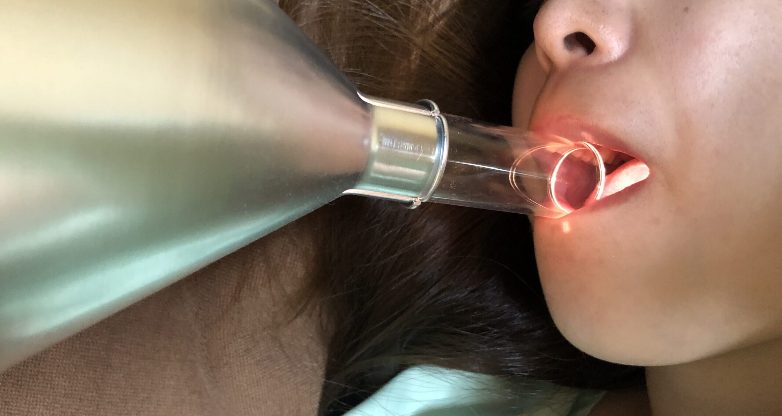 白板症のコウケントー光線治療で3001-5000番を使っていましたが、1000番を使った方がいいですか？