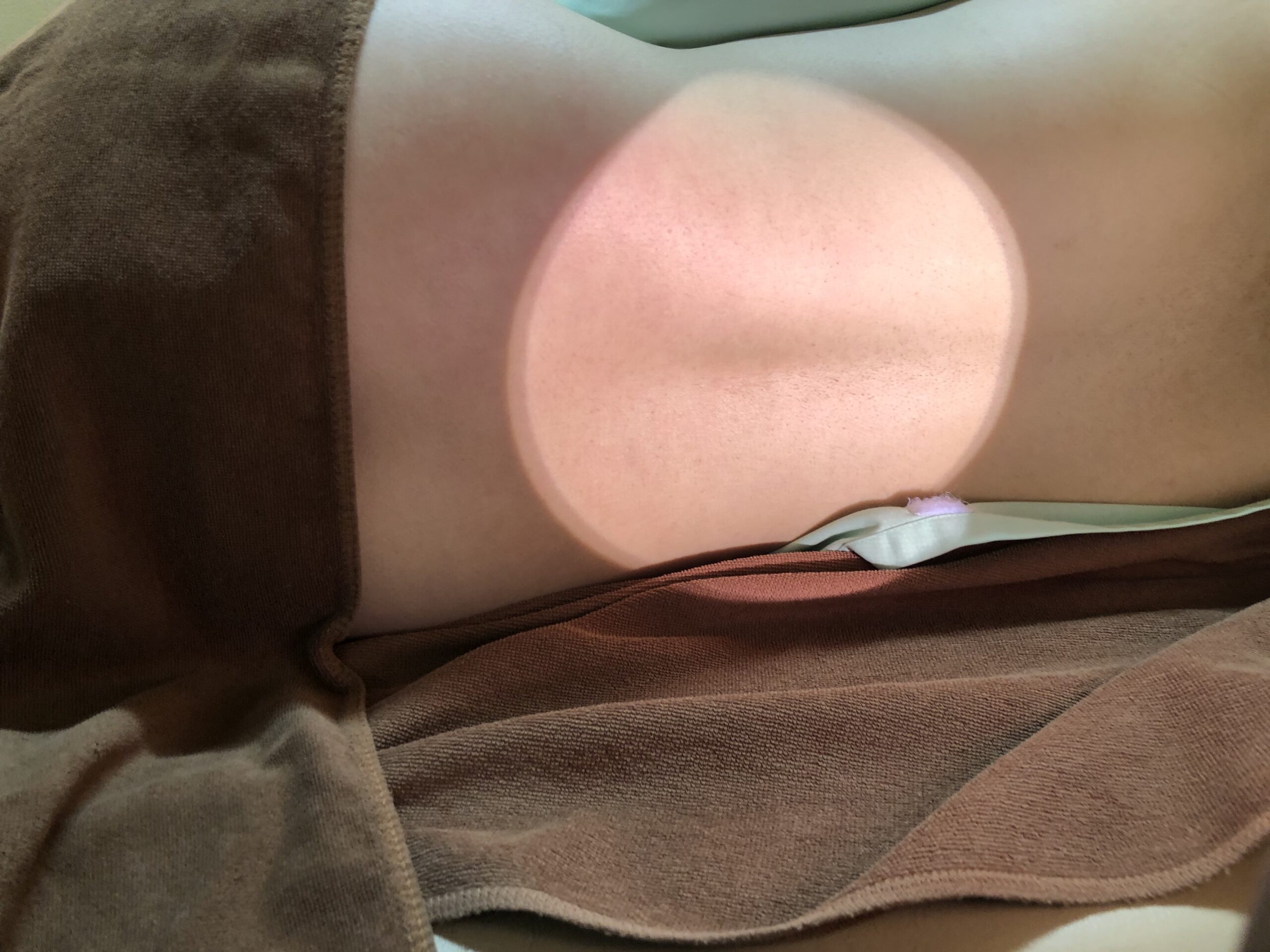 65歳男性、56歳女性他、慢性(進行性)糸球体腎炎のコウケントー光線治療