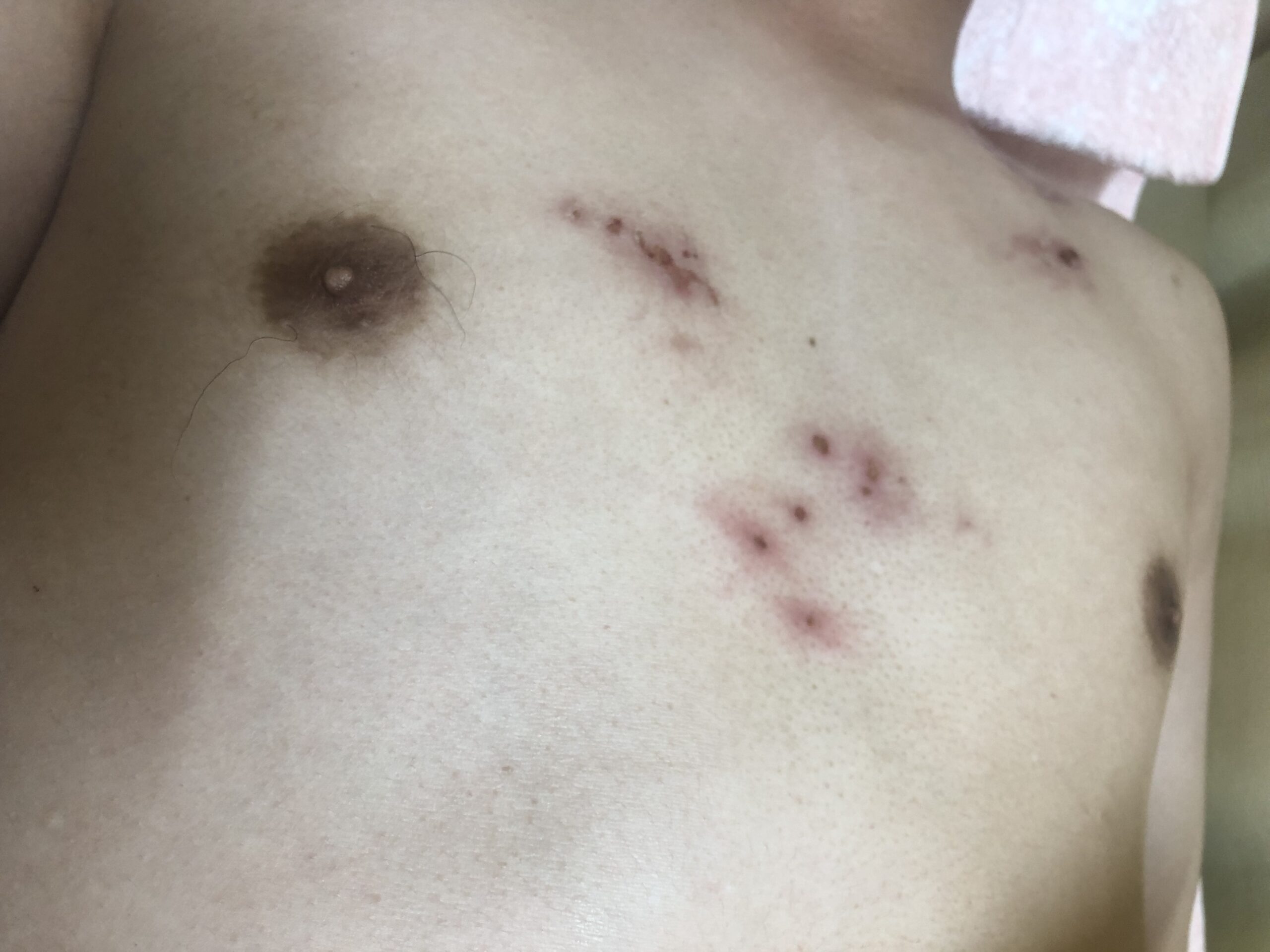 皮膚科で先生がこの原因はなんやろ？と言われた時のコウケントー光線治療