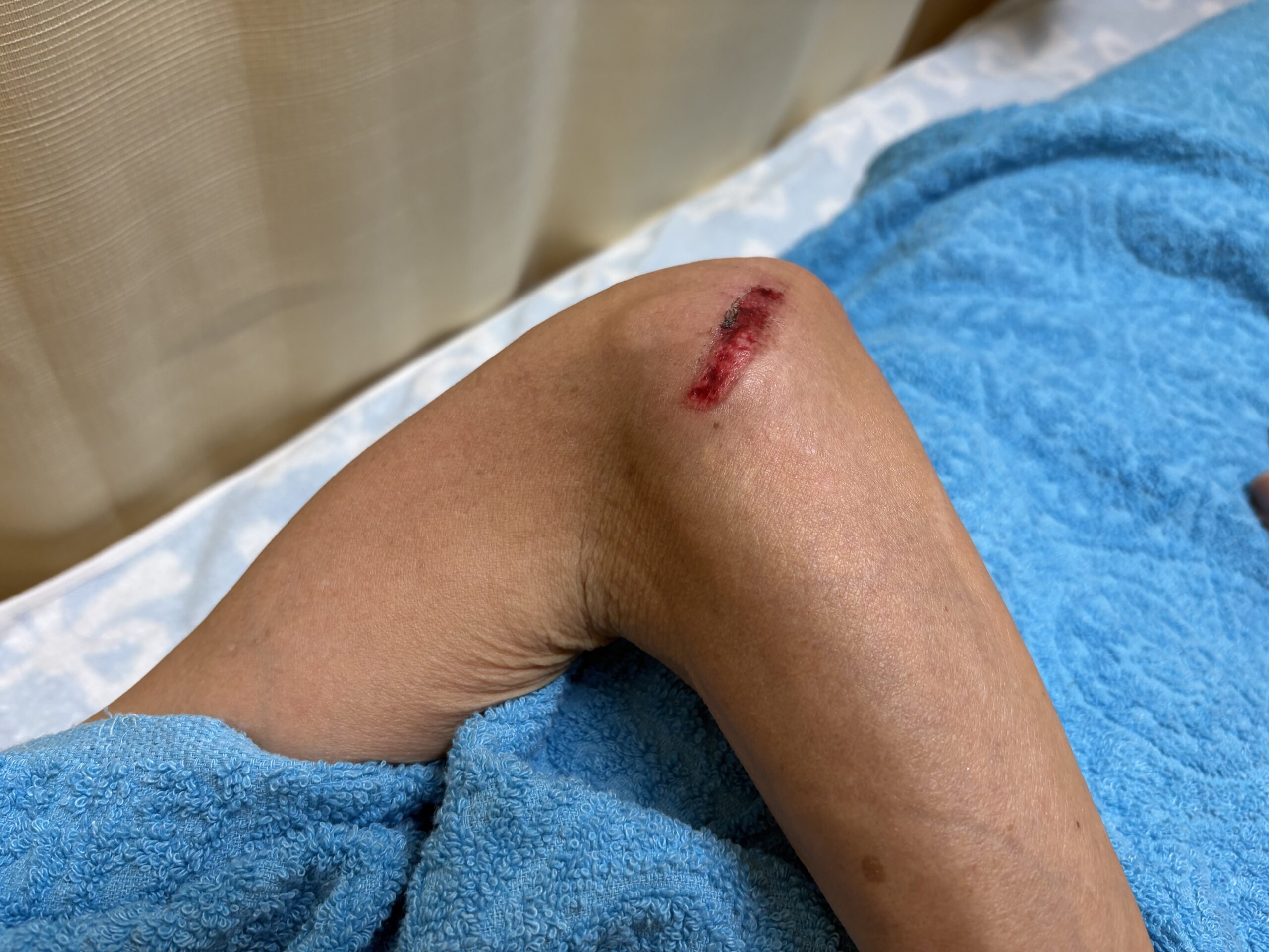 すり傷、切り傷などのコウケントー光線治療。