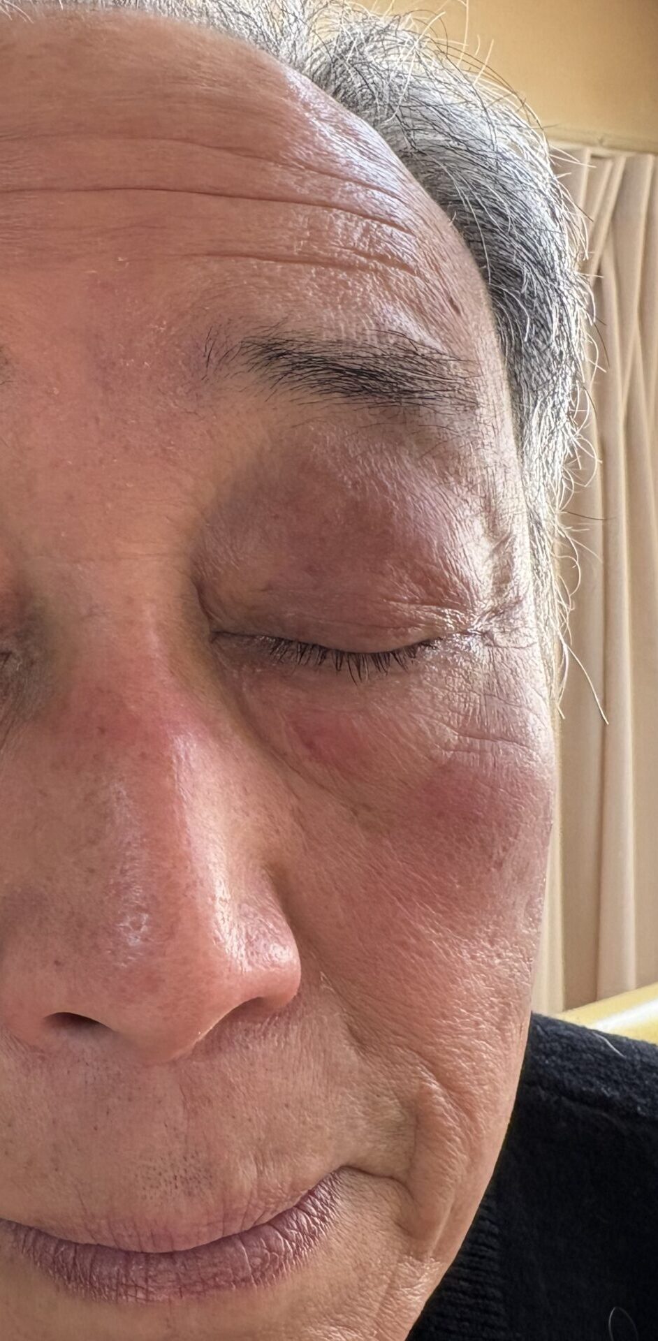 角膜欠損のコウケントー光線治療