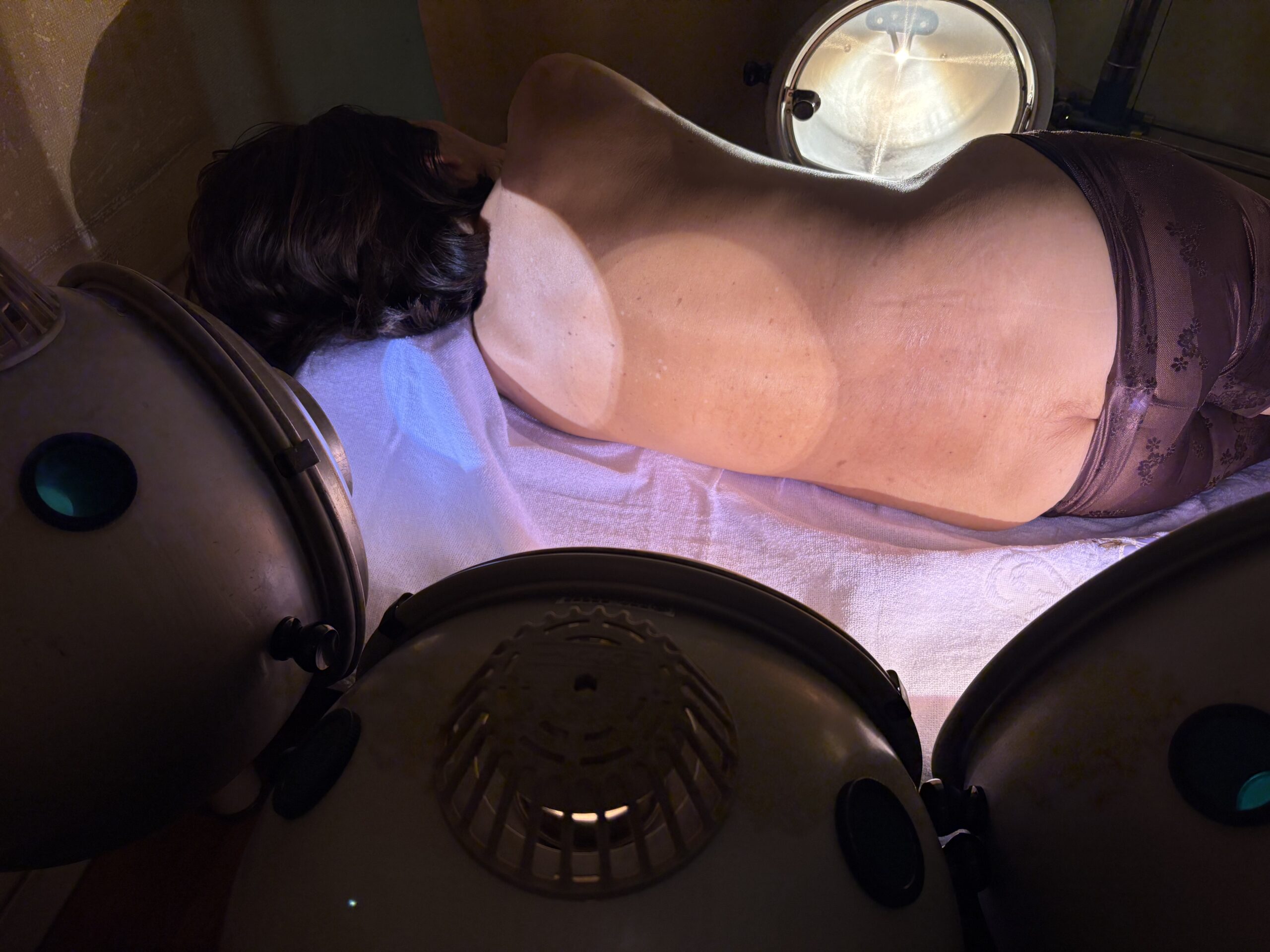 80代女性の腰椎圧迫骨折後のコウケントー光線治療で痛みを取り除く。