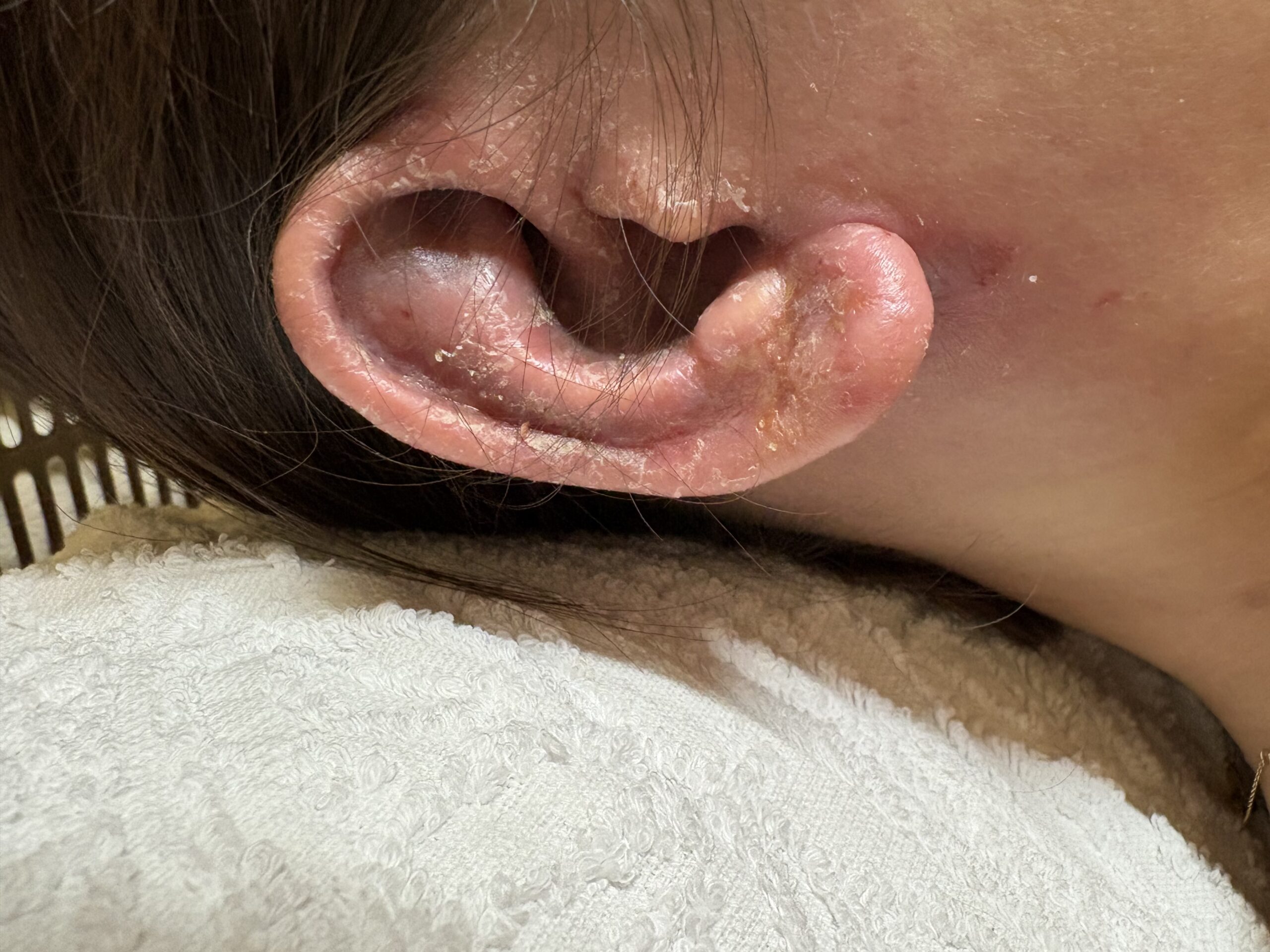 お顔も、首回りも、背中も綺麗なのに耳だけがアトピー性皮膚様になっている時のコウケントー光線治療