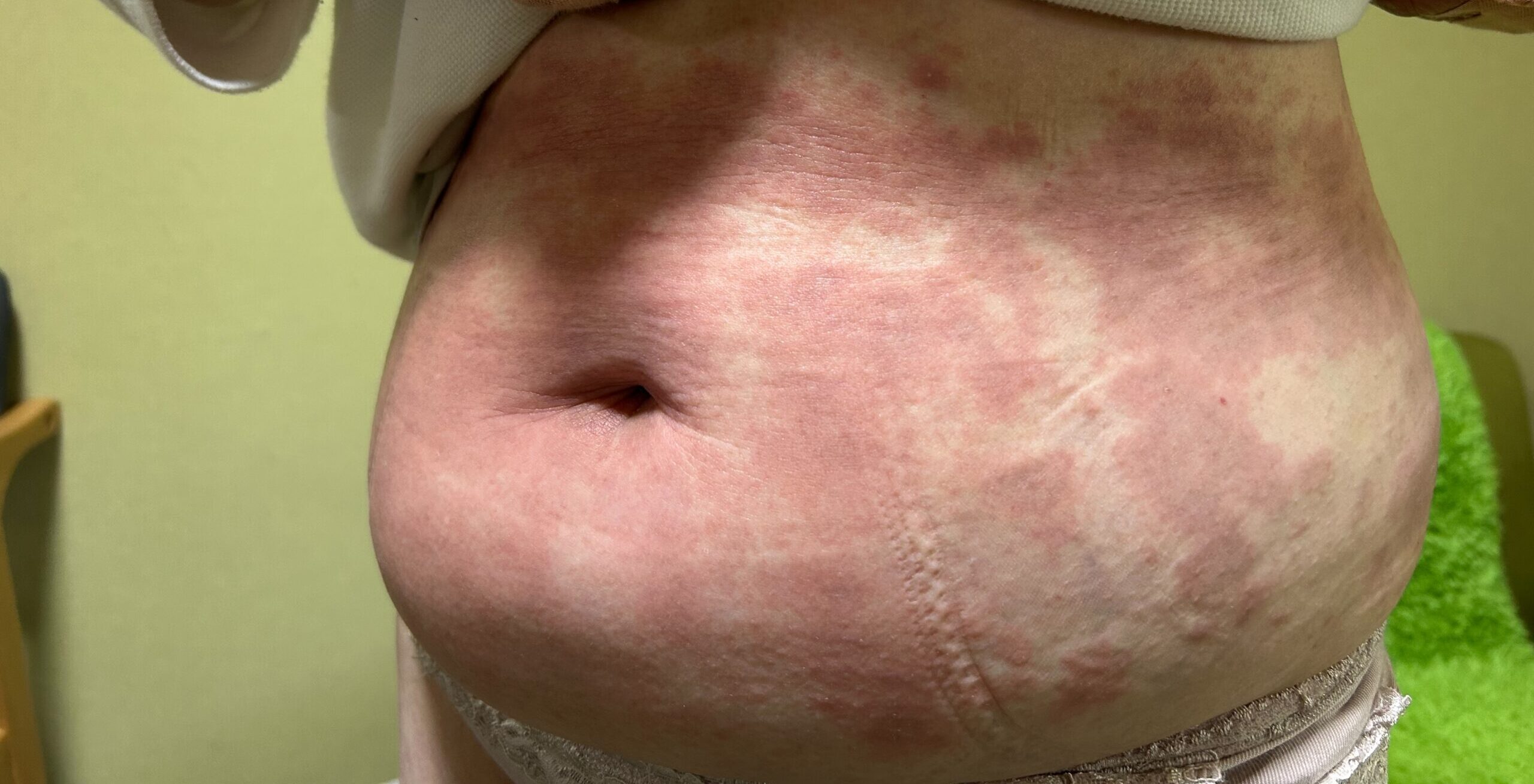 50代女性薬疹のコウケントー光線治療と、30代女性レチノールＡ反応のコウケントー光線治療。