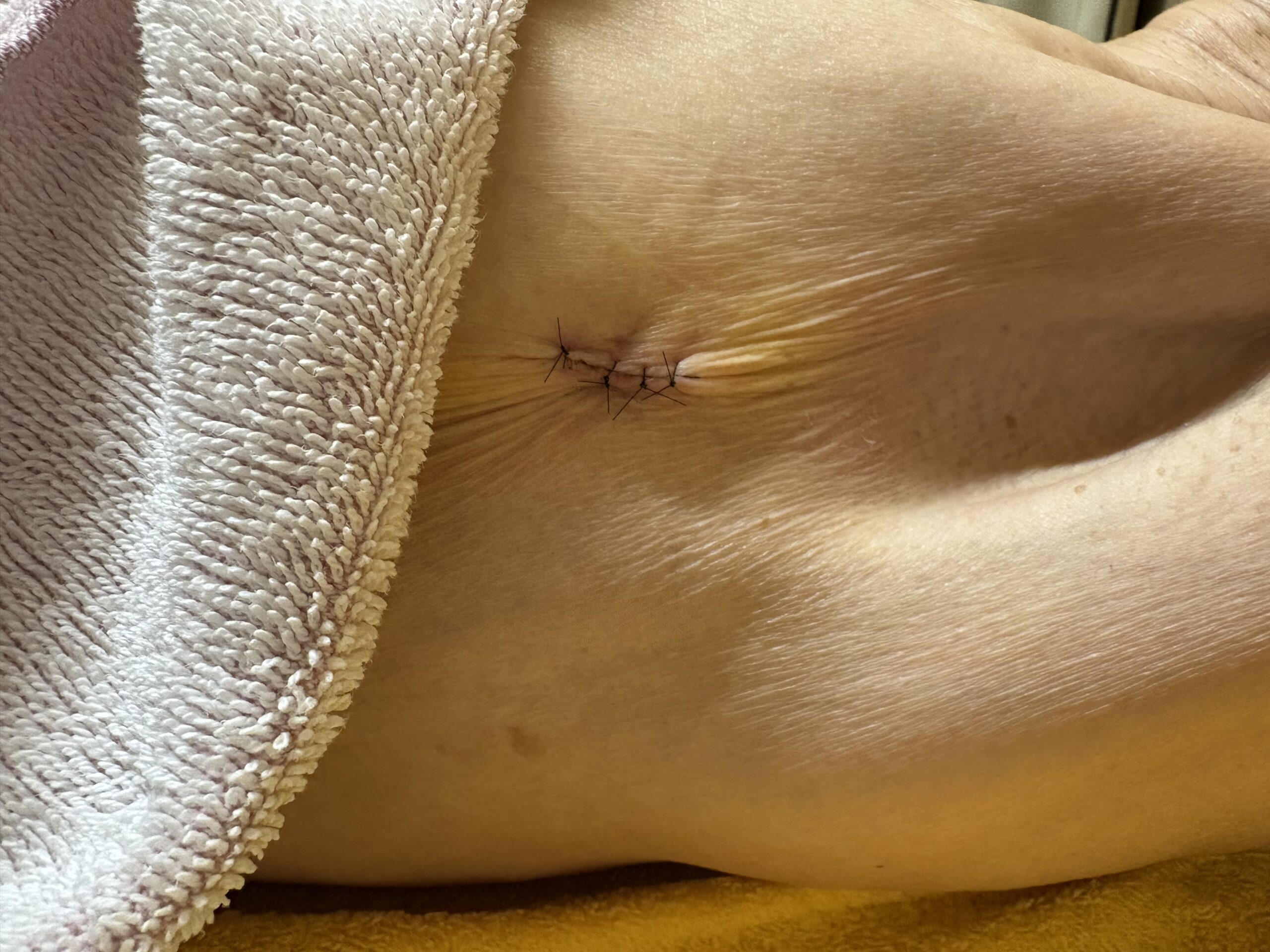 70代女性の腫瘍摘出後の傷口にコウケントー光線治療