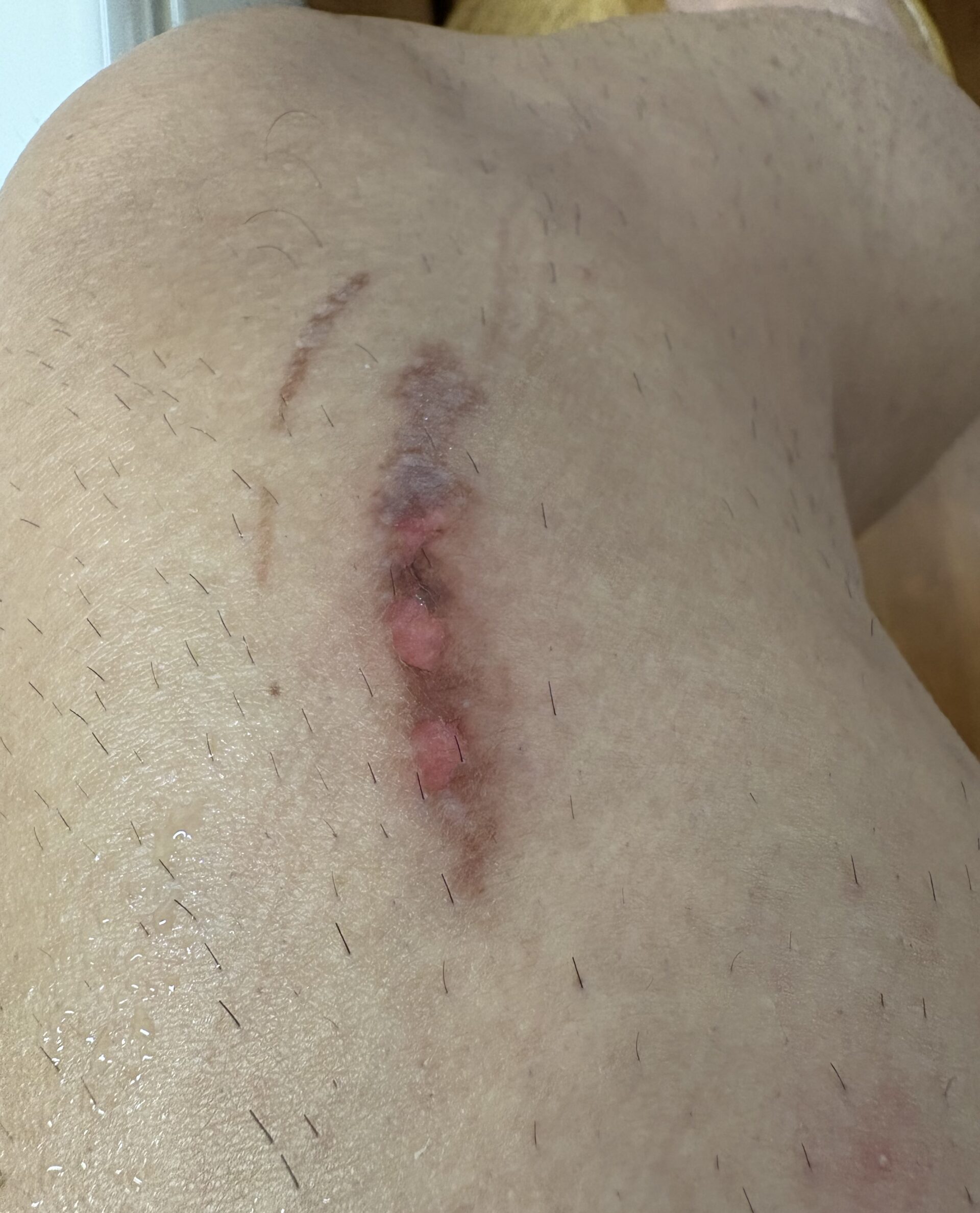 やけどや潰瘍などのコウケントー光線照射は直接にその部位に当てなくても効果は出ます。