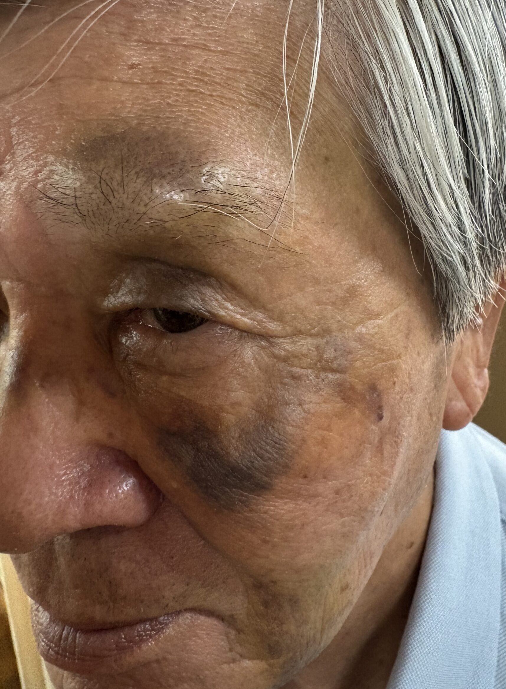 80代男性、「転んで顔面部を打撲したからコウケントー光線治療してちょ」