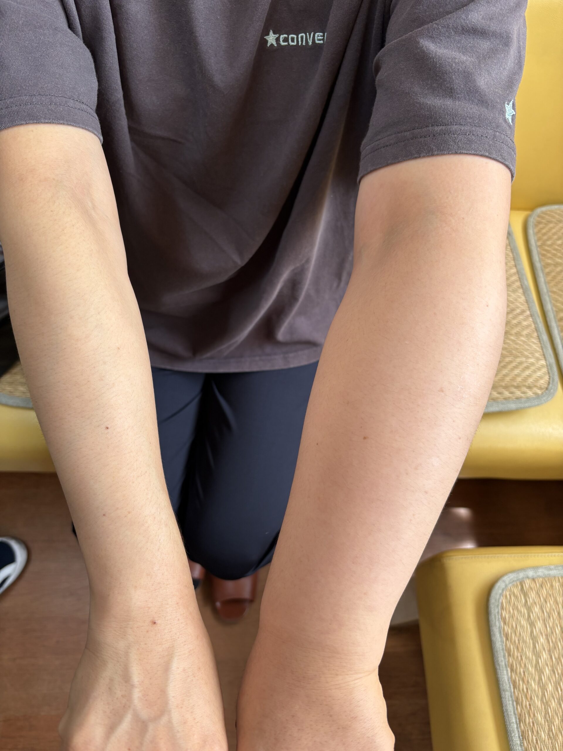 乳房全摘手術とリンパ節廓清で腕のリンパ浮腫が発生した時のコウケントー光線治療